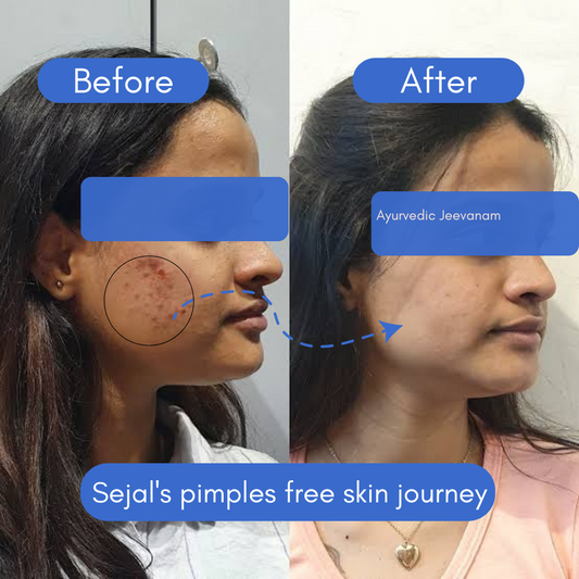 Sejal's Real Story: From Sun Tan & Pimples to Natural Glow! ✨